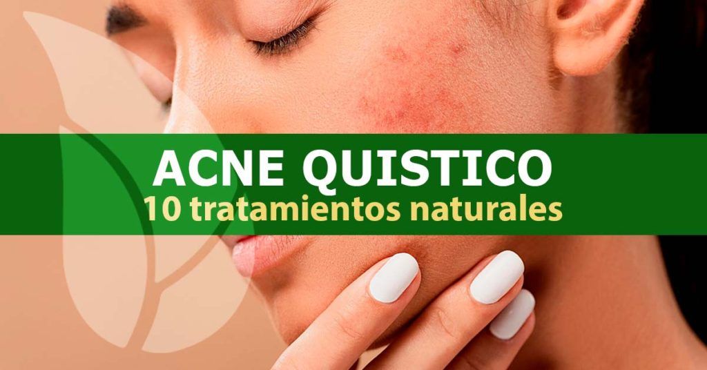 10-tratamientos-naturales-para-el-acné-quístico-blog