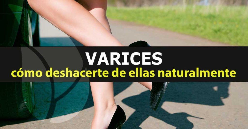 Varices-como-deshacerte-de-ella-natural-blog