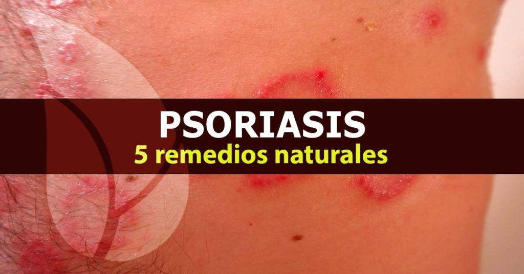 Psoriasis, 5 remedios naturales