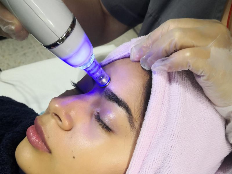 Mujer recibiendo tratamiento de microdermoabrasión
